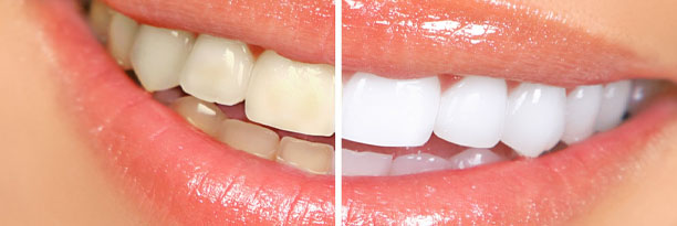 Blanqueamiento dental