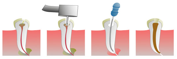 Tratamiento de endodoncia