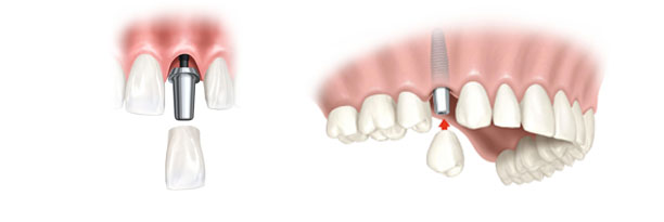 Implantes dentales