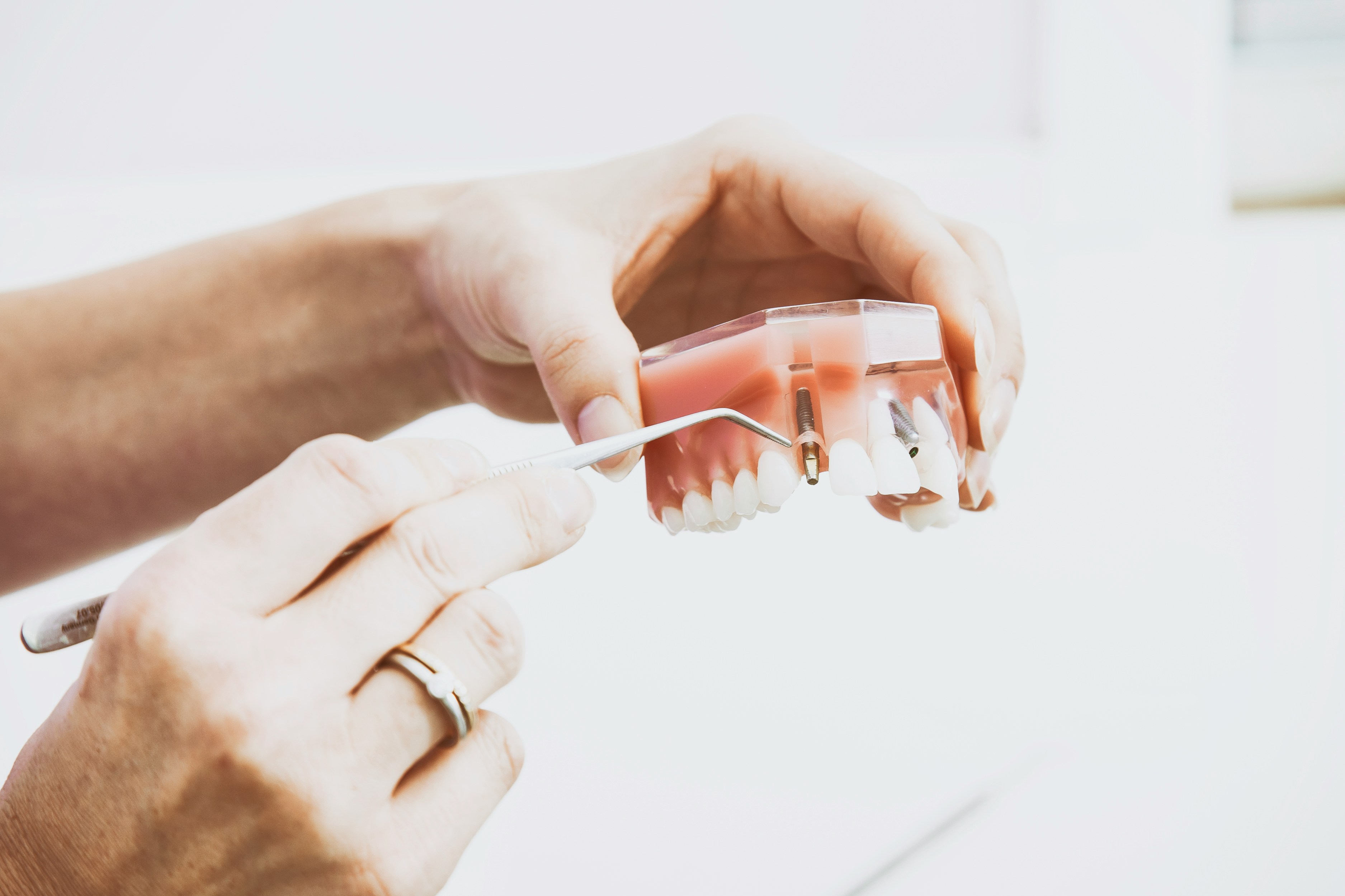 Implantes Dentales